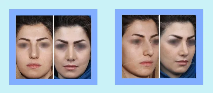 نمونه کار جراحی بینی زنانه 
