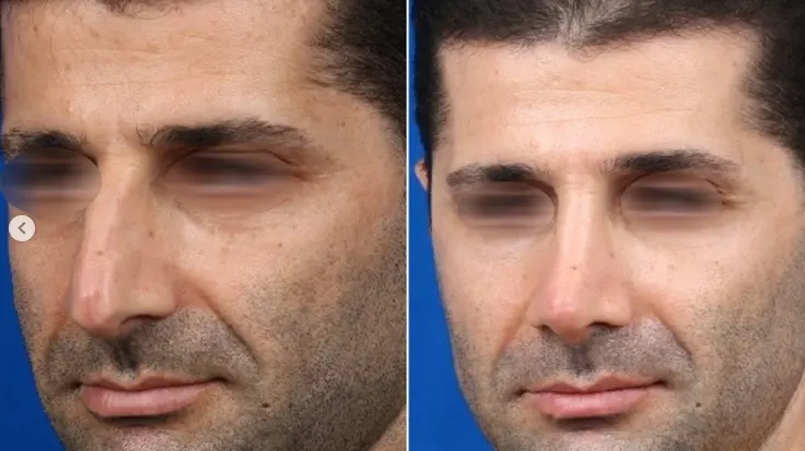 نمونه کار جراحی بینی دکتر حسنانی