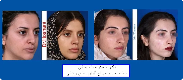 بینی قوزدار