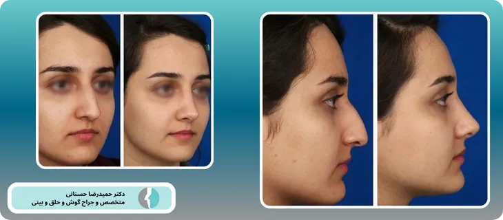 جراحی آندوسکوپی بینی