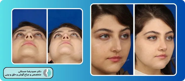 عمل بینی در سن پایین