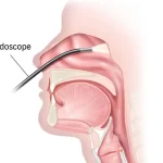 عمل آندوسکوپی بینی
