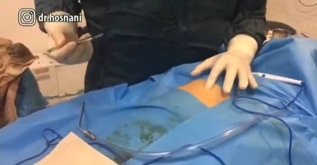 برداشتن غضروف دنده