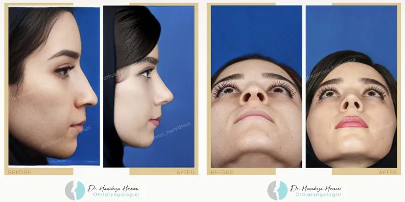 ترمیم بینی با غضروف دنده