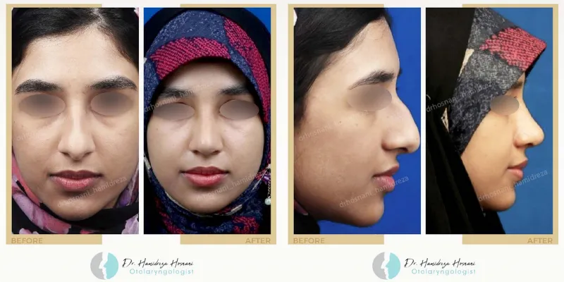 ضربه به بینی بعد جراحی