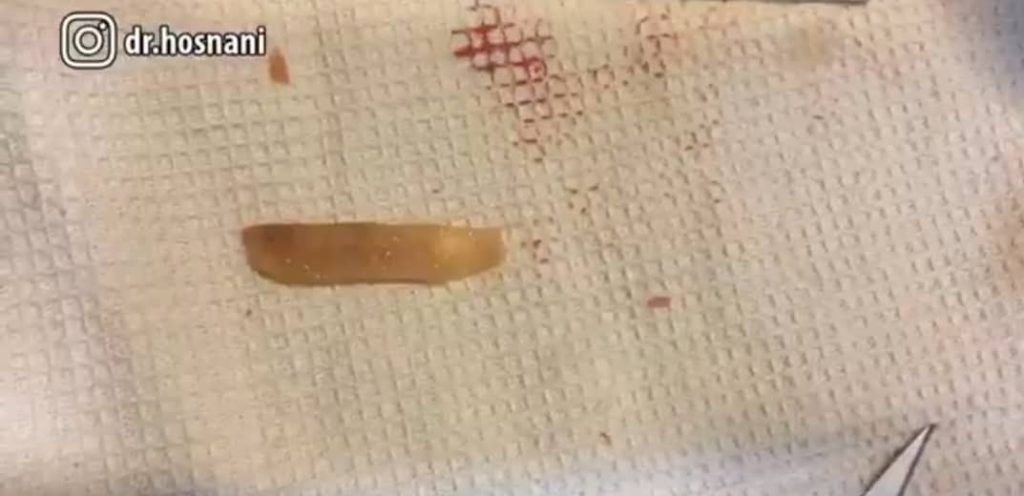 غضروف دنده - جراحی بینی