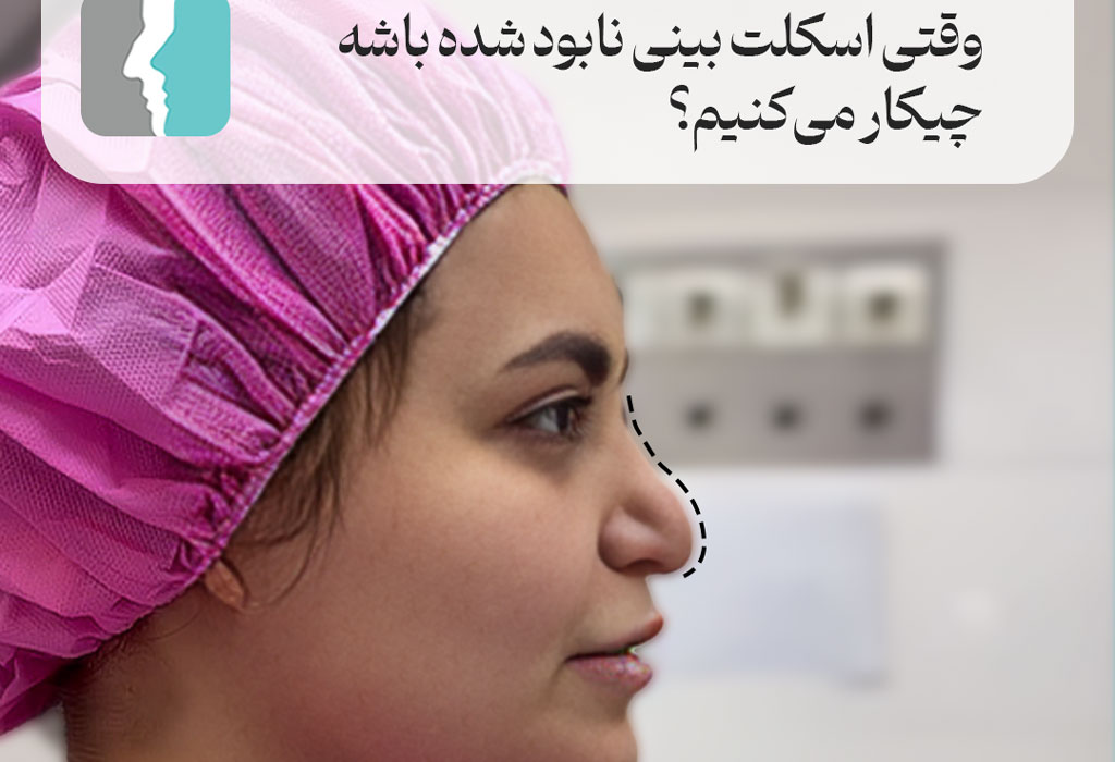بازسازی اسکلت بینی