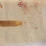 غضروف دنده - جراحی بینی