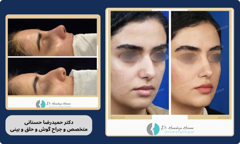 برداشتن قوز بینی با فیلر