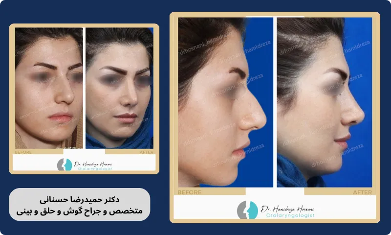 برداشتن قوز بینی با نخ