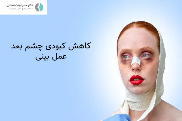 کاهش کبودی بعد عمل بینی