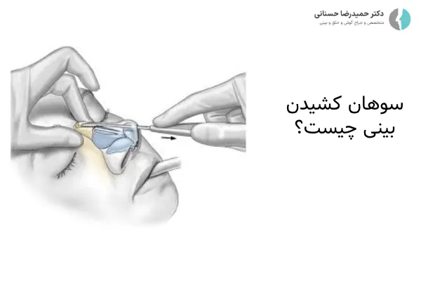 سوهان کشیدن بینی چیست؟