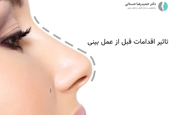 تاثیر اقدامات قبل از عمل بینی