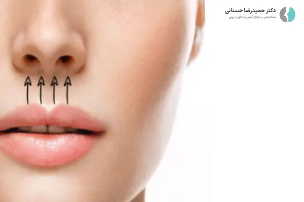 فاصله لب و بینی بعد از عمل بینی چقدره؟