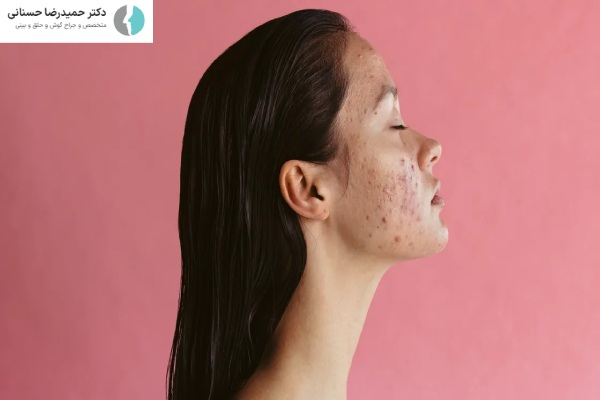 جوش صورت بعد از جراحی بینی