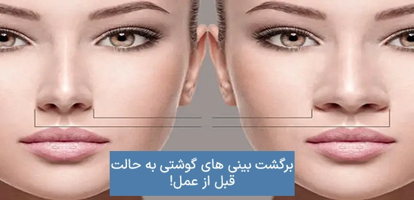 برگشت بینی های گوشتی به حالت قبل از عمل