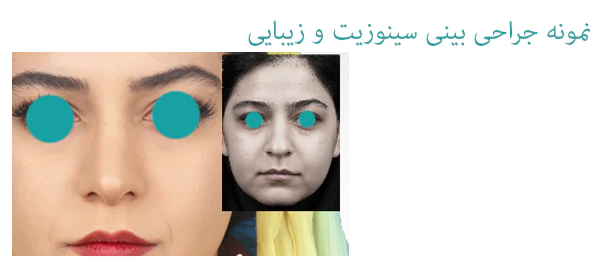 جراحی سینوزیت و زیبایی بینی