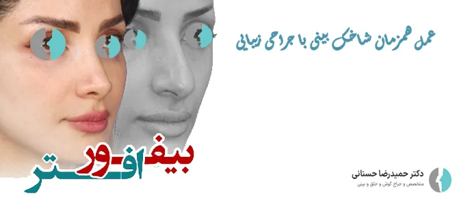 جراحی همزمان زیبایی و شاخک های بینی
