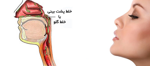 خلط پشت گلو