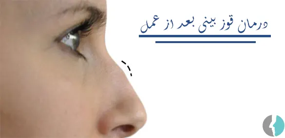 درمان قوز بینی بعد از عمل