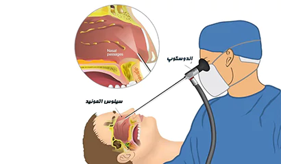 عمل اندوسکوپی سینوس