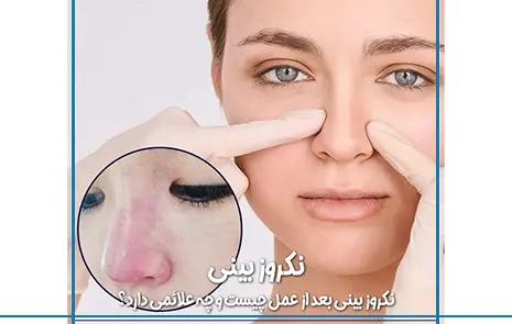 نکروز بینی