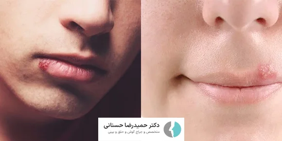 پیشگیری از تبخال قبل عمل بینی