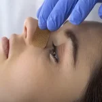 برگشت فرم بینی گوشتی