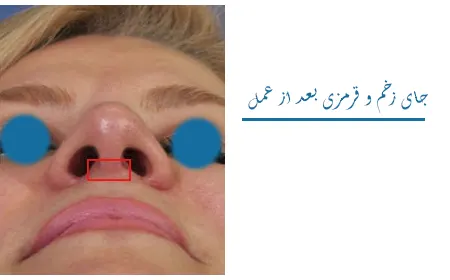 جای زخم و قرمزی بعد عمل