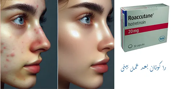 راکوتان بعد عمل بینی