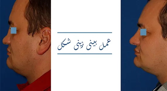 عمل بینی زینی شکل