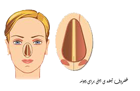 غضروف تیغه بینی برای پیوند