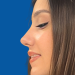 جراحی بینی استخوانی