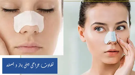 تفاوت بینی باز و بسته