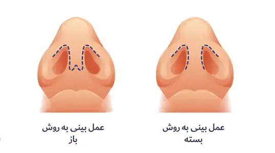 تفاوت جراحی باز و بسته بینی