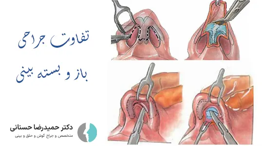 تفاوت جراحی بینی باز و بسته