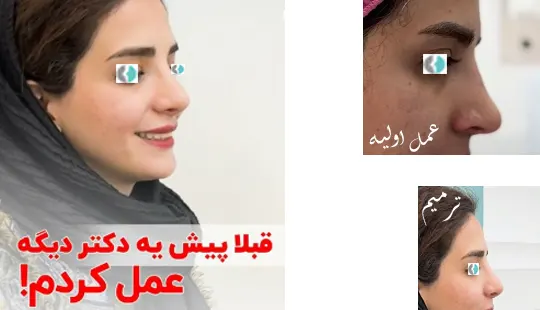 عمل ترمیمی بینی