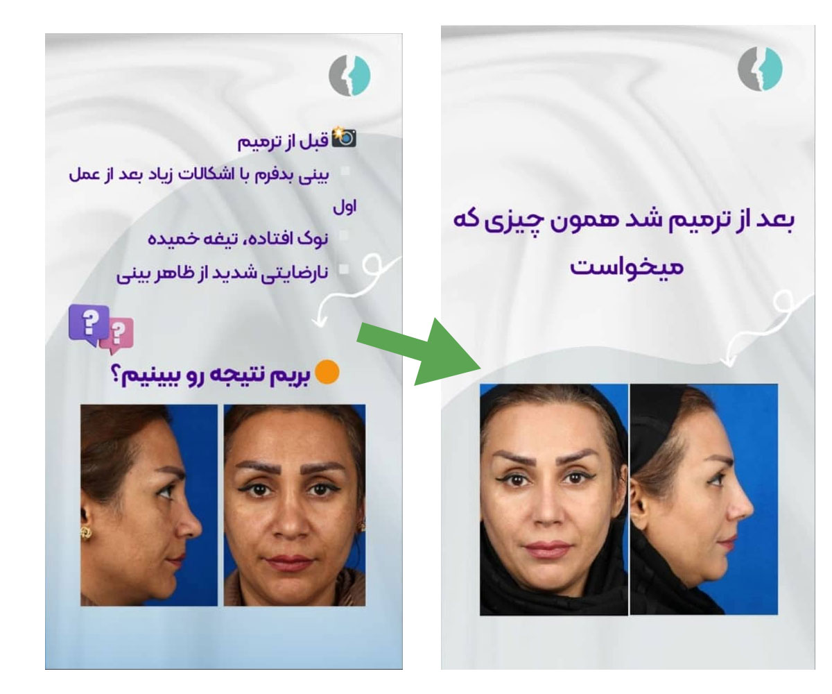 نمونه ترمیم بینی با دکتر حسنانی