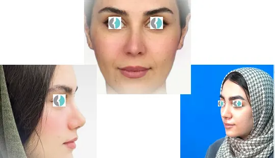 نمونه کار عمل بینی ترمیمی