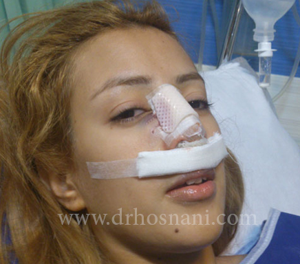 ﻿اسپلینت بینی را برای مدت یک هفته دست نزنید و جابجا نکنید. 