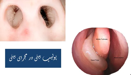 پولیپ بینی در مجرای بینی