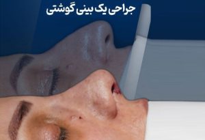 عمل بینی گوشتی