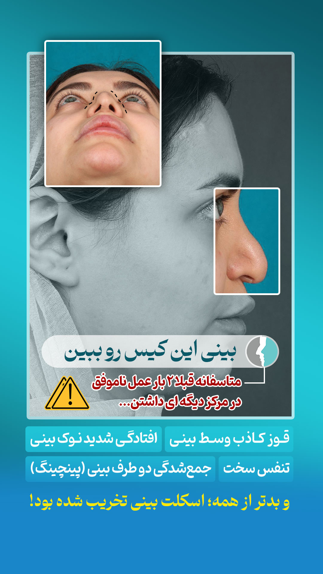 عمل جراحی بینی ترمیمی