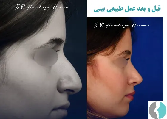 عکس قبل و بعد عمل طبیعی بینی