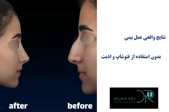 نتایج واقعی عمل بینی