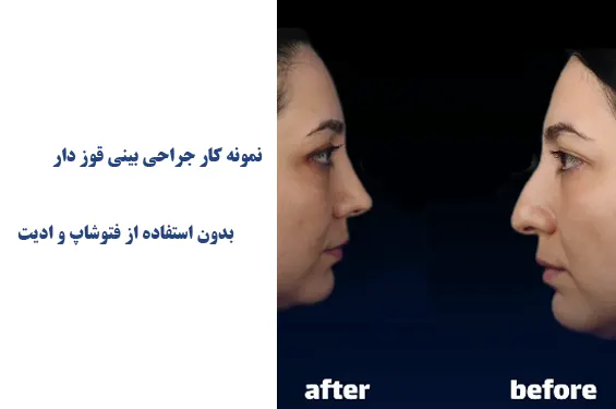 نمونه کار جراحی بینی قوز دار