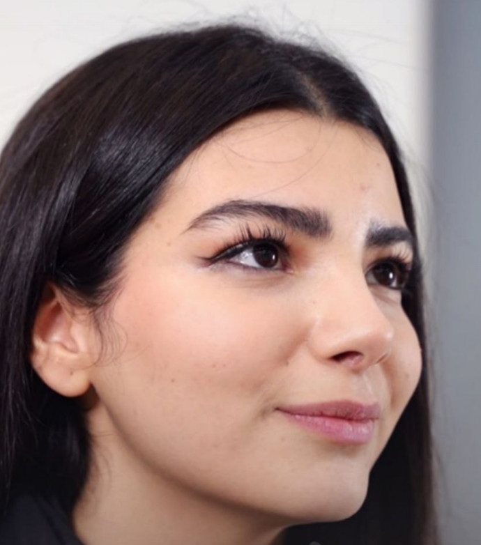 بینی طبیعی بعد از سه ماه