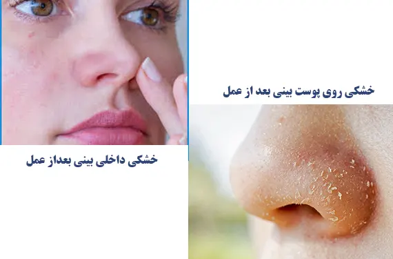 انواع خشکی بینی بعد از جراحی بینی