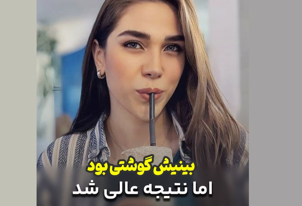 نتیجه عالی بینی گوشتی